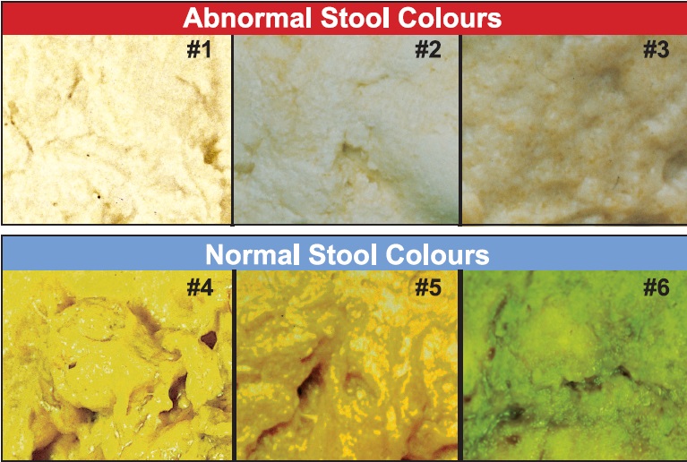 Stool Colour Chart 